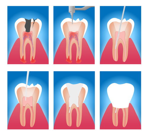 Root canal treatment procedure