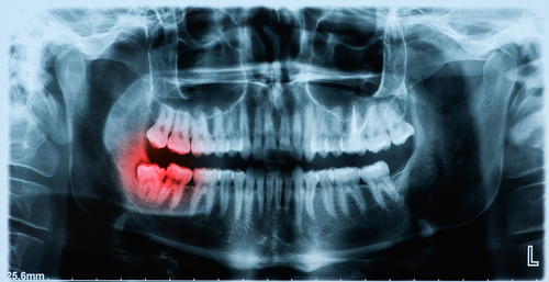 wisdom teeth x-ray for removal vaughan