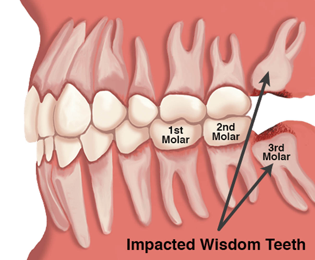 Wisdom Teeth removal vaughan