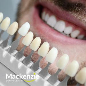 3 Common Misconceptions About Dental Veneers