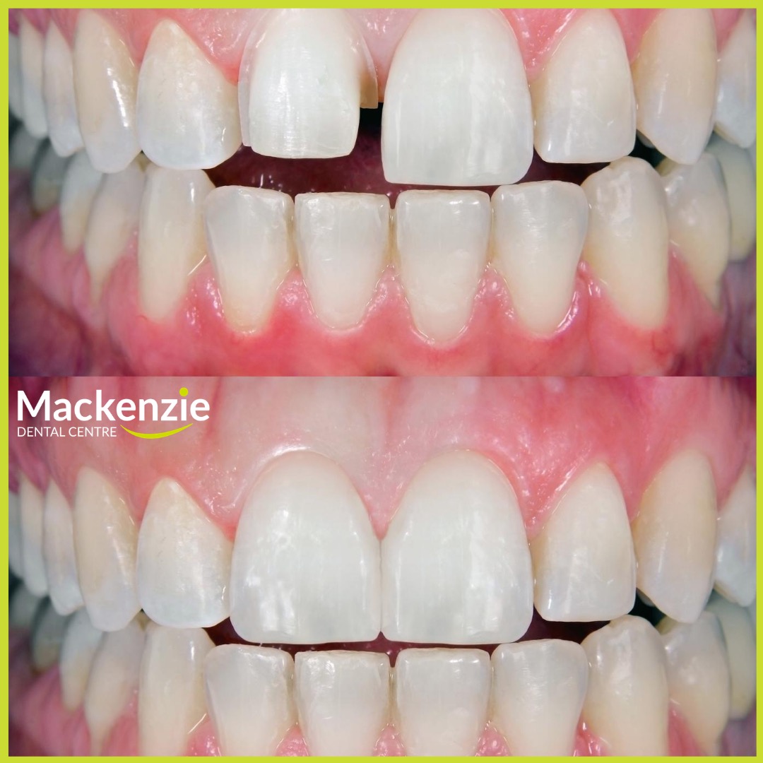 dental veneers