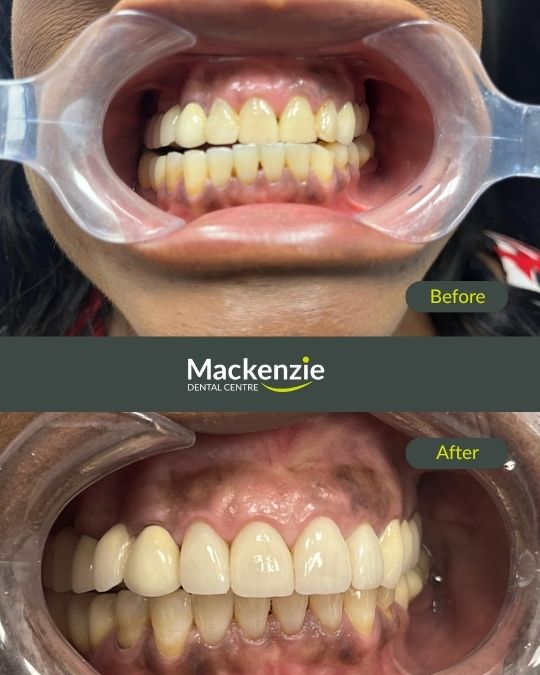dental veneer before and after by dr. lloyd pedvis