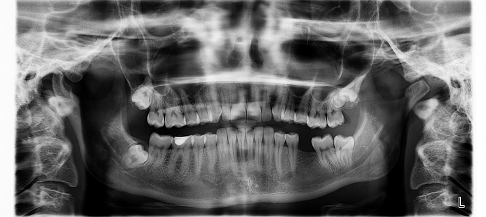 best dental implants xray 