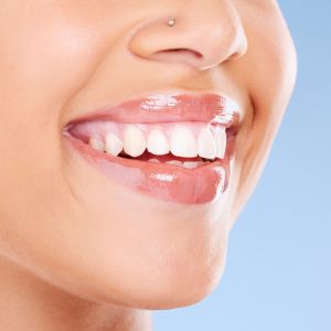 Can Veneers be the Perfect Solution for Your Dental Imperfections