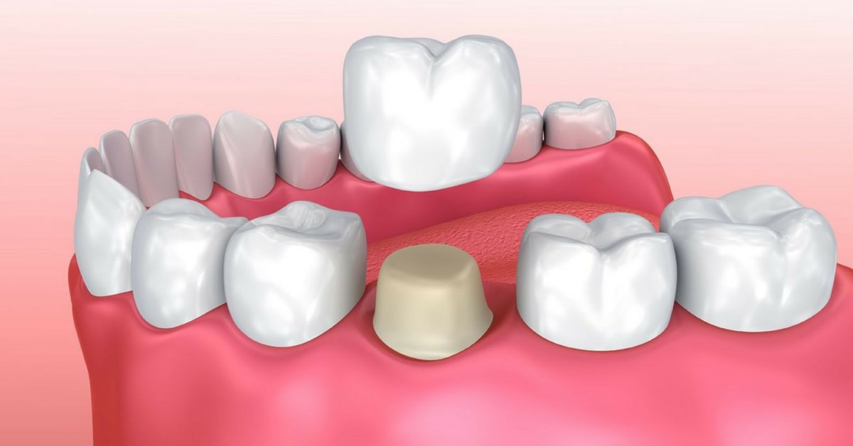 dental crown