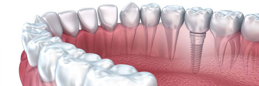 Dental Implants vaughan