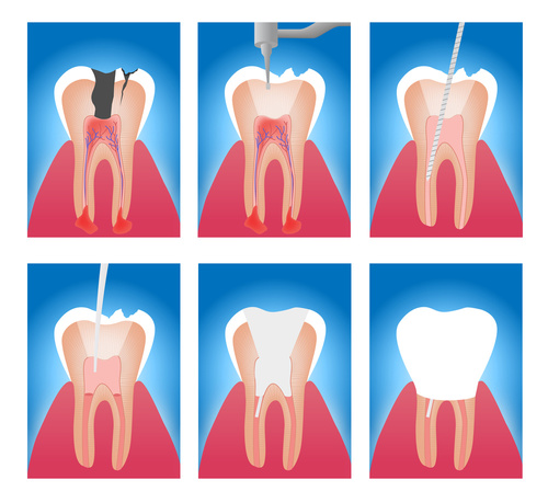 Root Canal Treatment 