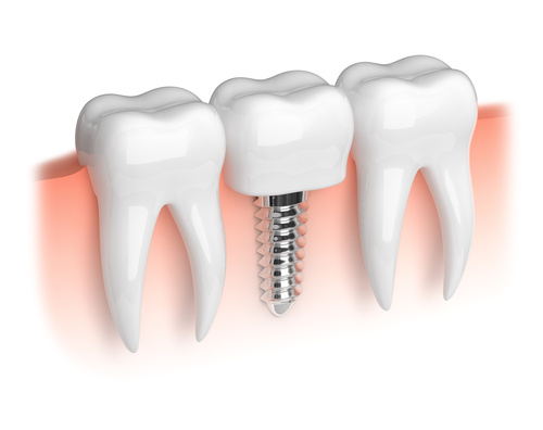 dental implants dentist woodbridge 