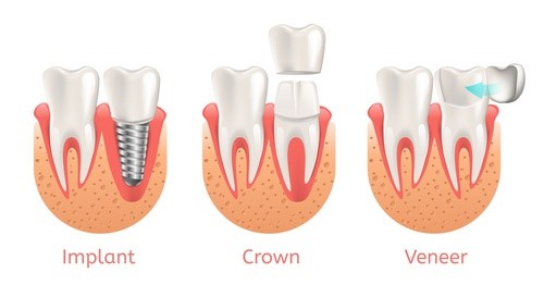 dental Implants Crowns Veneers vaughan