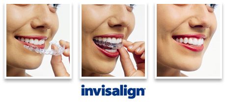 invisalign clear braces vaughan