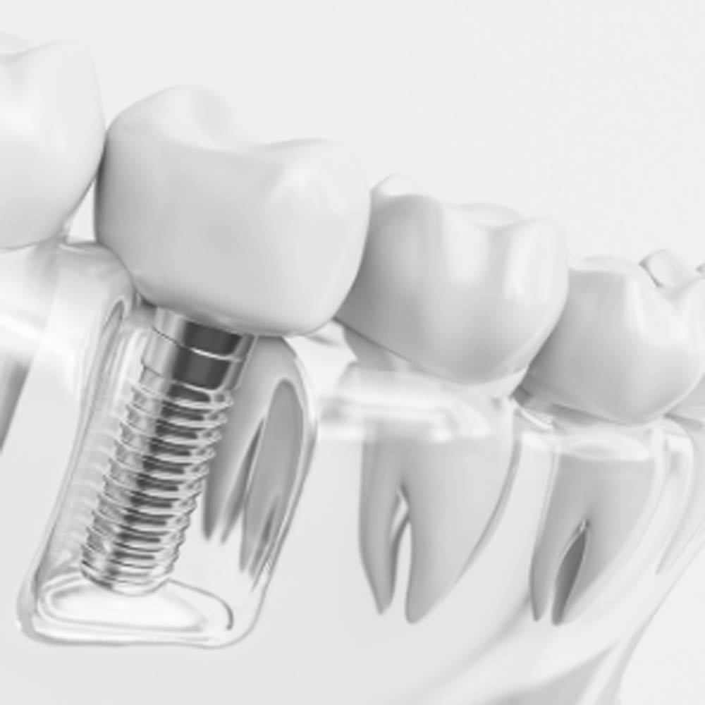dental implant for missing tooth