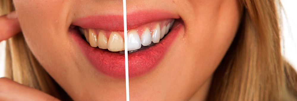 foods that stain your teeth vaughan