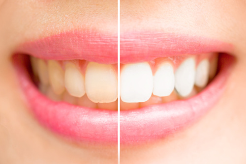 professional teeth whitening vaughan