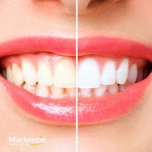 teeth whitening