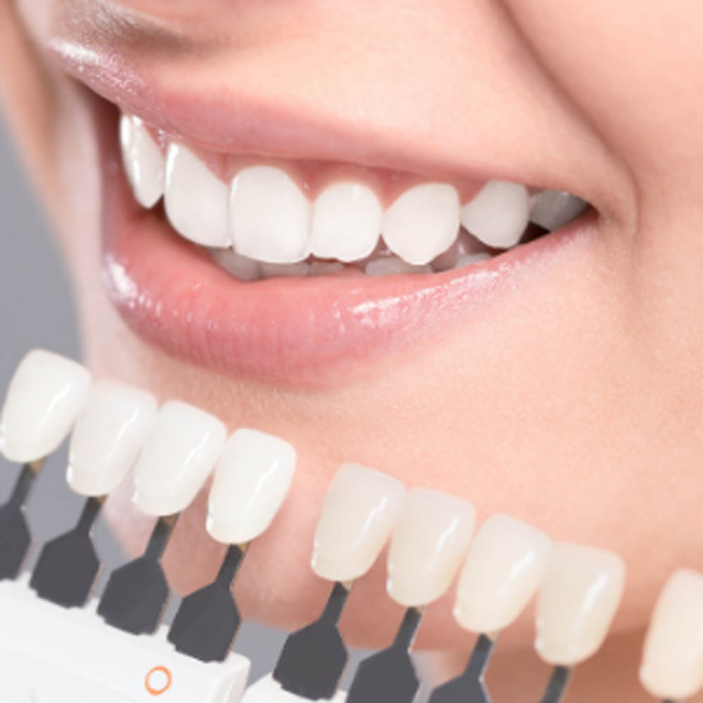 teeth whitening dentist vaughan