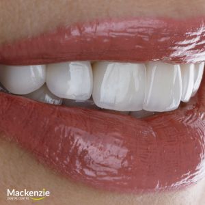 veneers dentist