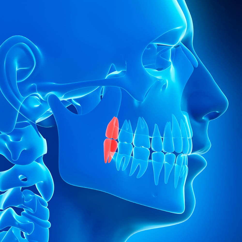 Dental scan of impacted wisdom teeth