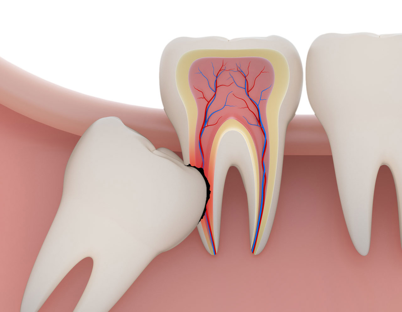 Impacted wisdom tooth vaughan